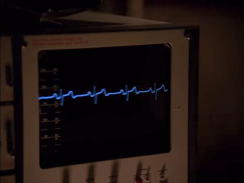 EKG in hospital