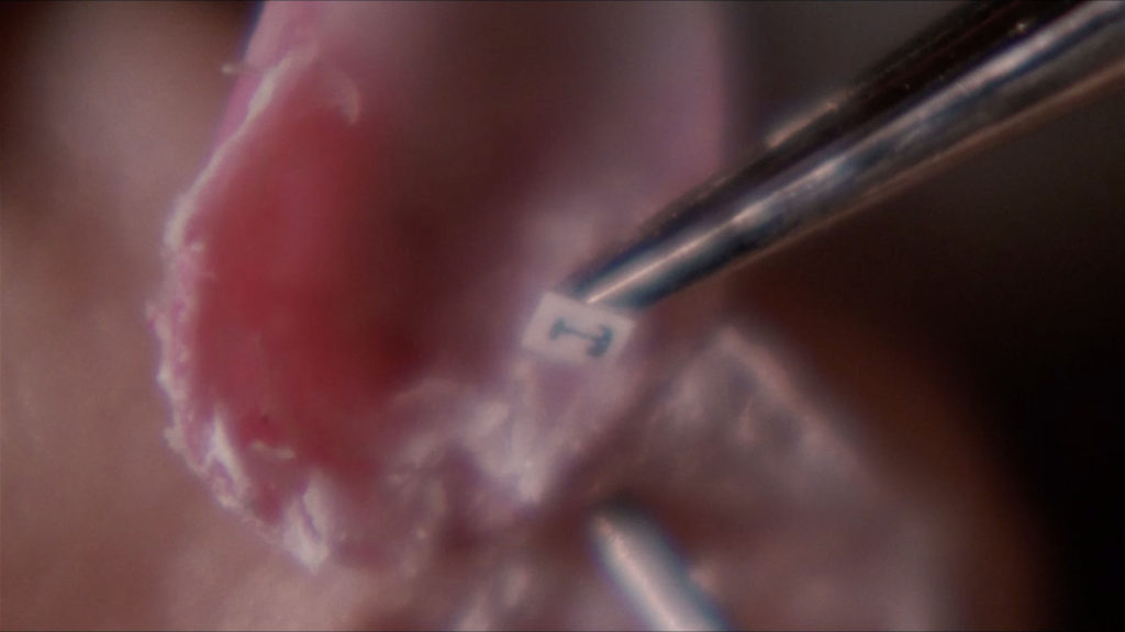 Close Up of a finger nail being removed by tweezers
