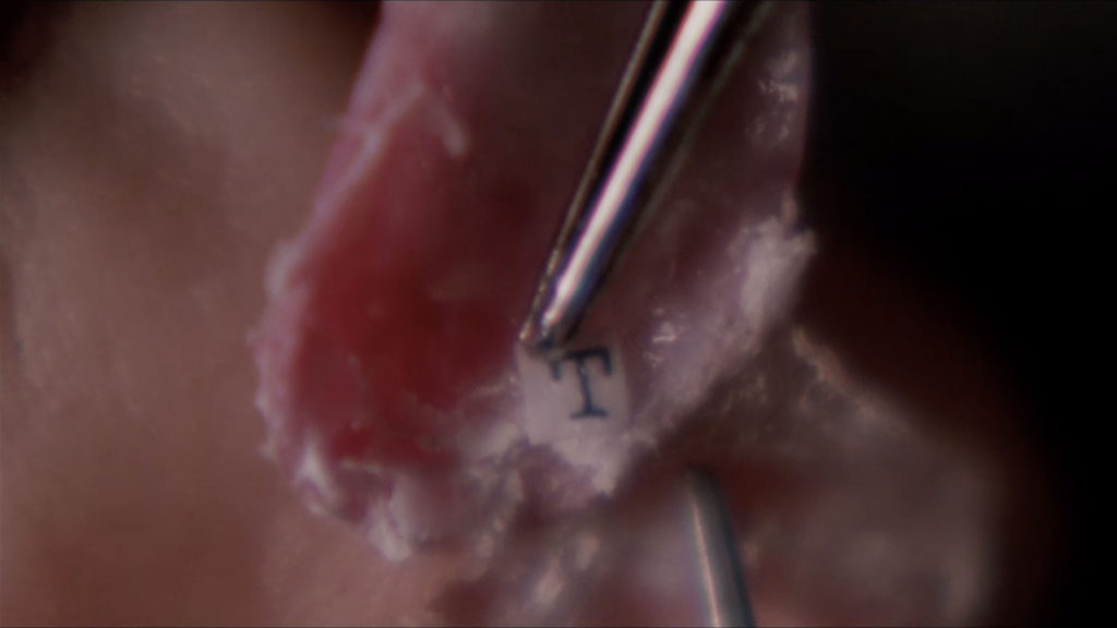 Tweezers holding a small piece of paper with the letter "T" under a removed fingernail